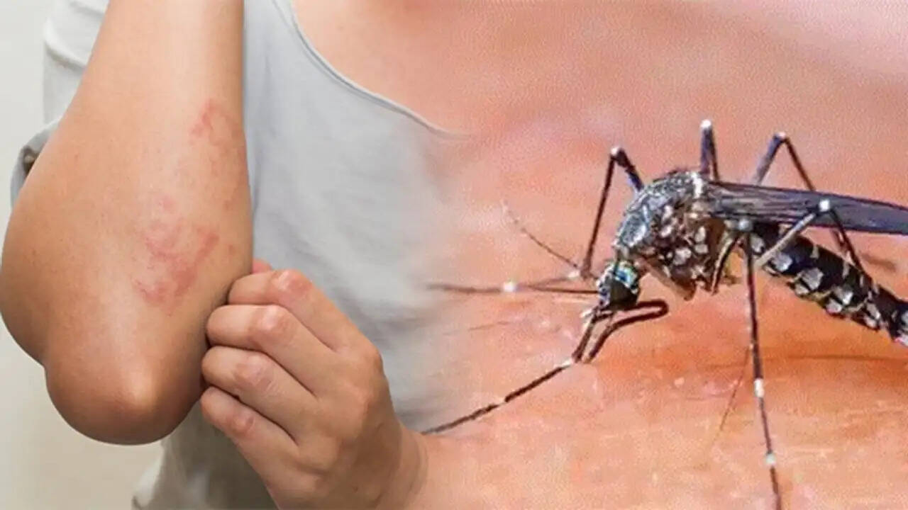Dengue से जल्द होना चाहते हैं रिकवर, तो अपनाएं ये आसान टिप्स