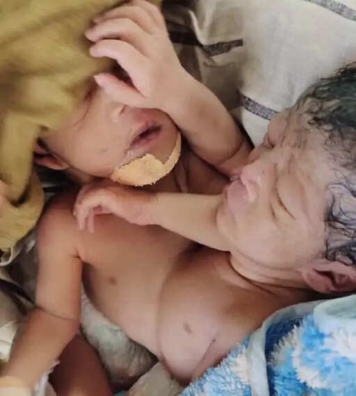हरियाणा में पैदा हुई जुड़वा बच्चियां , हाथ, पैर ,और सिर अलग, पर दोनों में धड़क रहा एक दिल