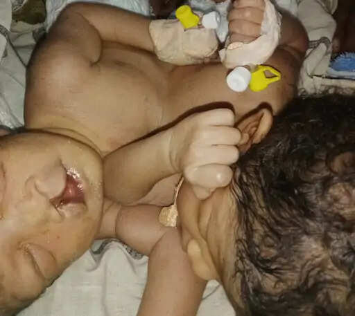 हरियाणा में पैदा हुई जुड़वा बच्चियां , हाथ, पैर ,और सिर अलग, पर दोनों में धड़क रहा एक दिल